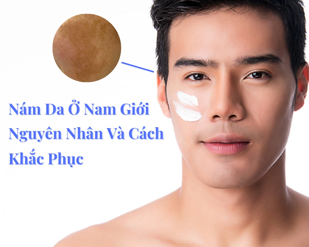 Nám Da Mặt Ở Nam Giới: Nguyên Nhân Và Cách Khắc Phục Hiệu Quả